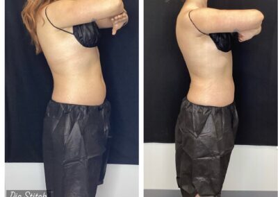 CoolSculpting before and after photos by UniQ Laser Center in Canton, MA