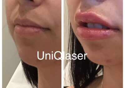 Juvederm Voluma before and after photos by UniQ Laser Center in Canton, MA