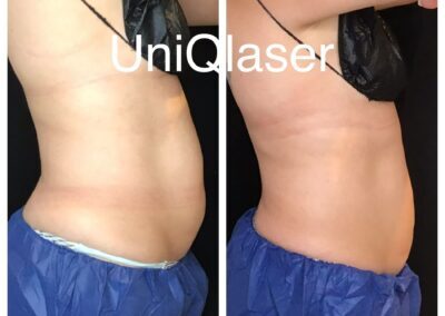 CoolSculpting before and after photos by UniQ Laser Center in Canton, MA