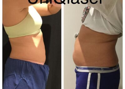 CoolSculpting before and after photos by UniQ Laser Center in Canton, MA