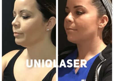 CoolSculpting before and after photos by UniQ Laser Center in Canton, MA