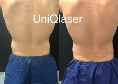 CoolSculpting before and after photos by UniQ Laser Center in Canton, MA