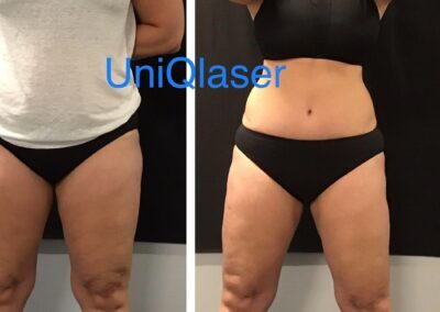 CoolSculpting before and after photos by UniQ Laser Center in Canton, MA