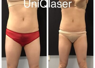 CoolSculpting before and after photos by UniQ Laser Center in Canton, MA