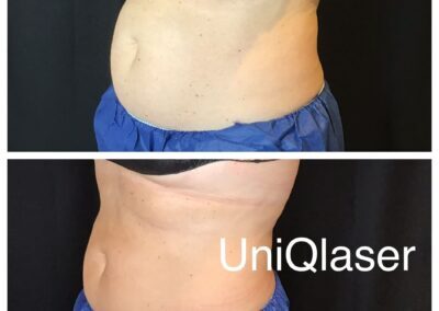 CoolSculpting before and after photos by UniQ Laser Center in Canton, MA